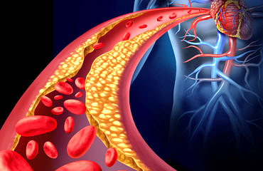 Does cholesterol cause heart disease