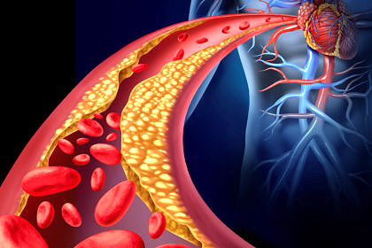 Does cholesterol cause heart disease