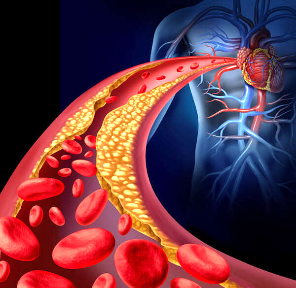 Does cholesterol cause heart disease